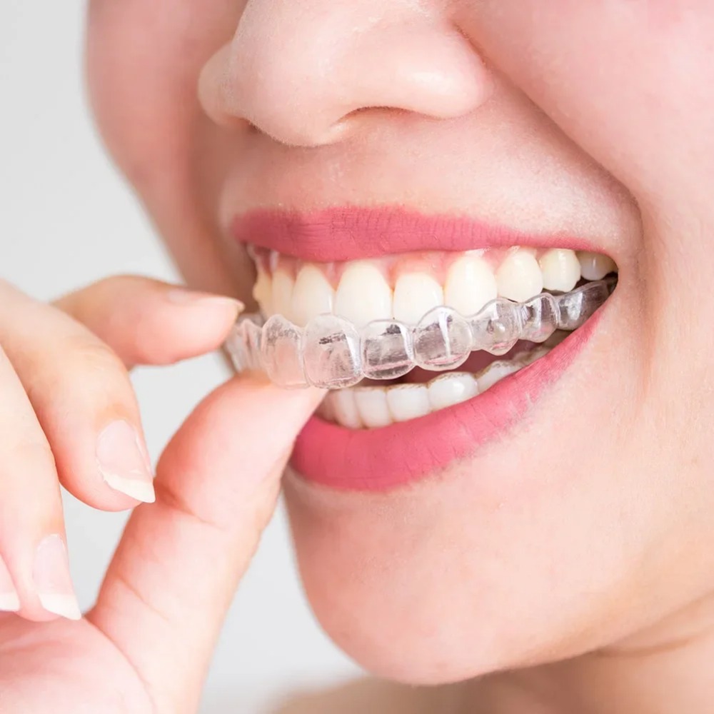 Dental Guard Night - 1-4 unidades Protector bucal antirronquidos y