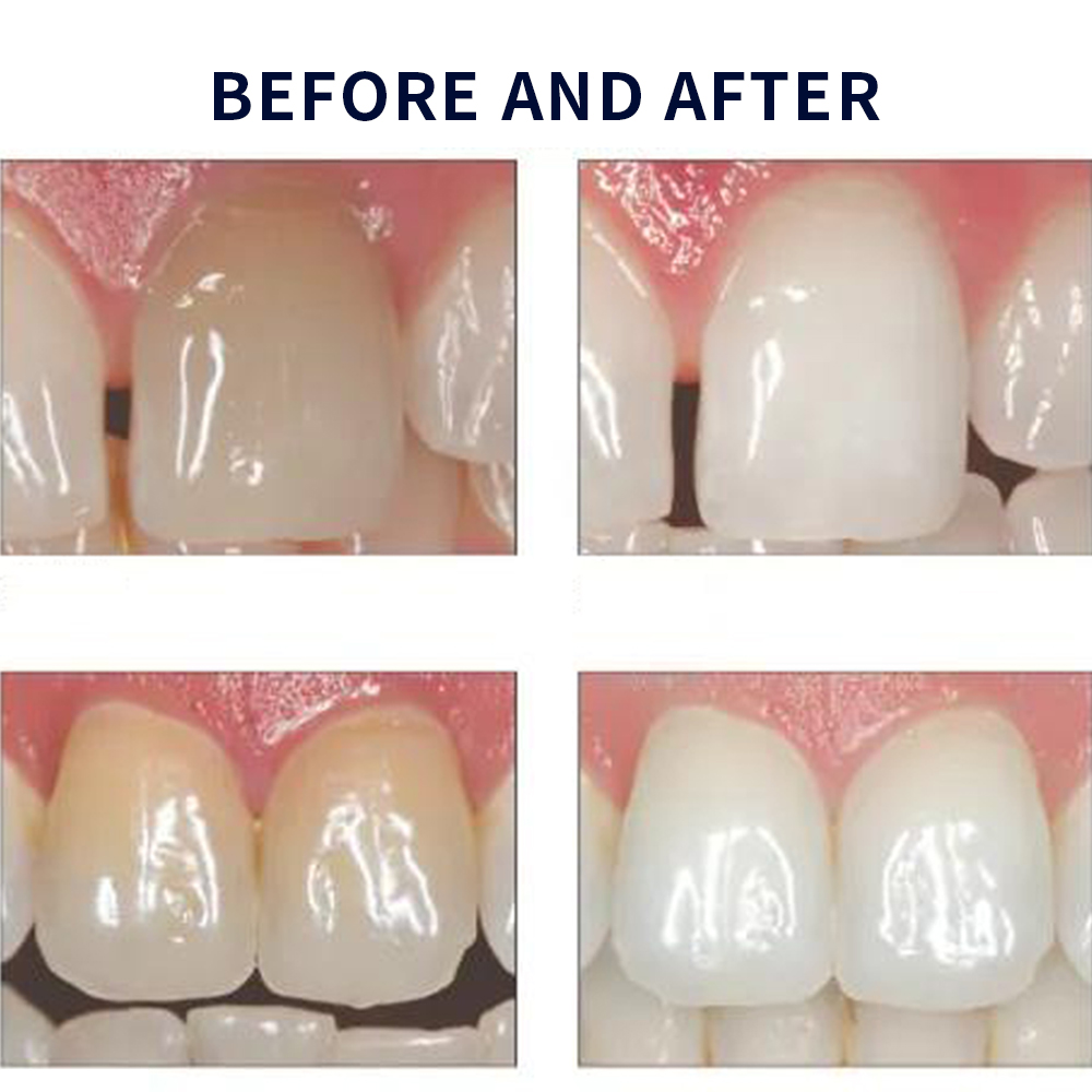 Opalescencia blanqueadora 20%  - Teeth Whitening Ulta reseña y precio