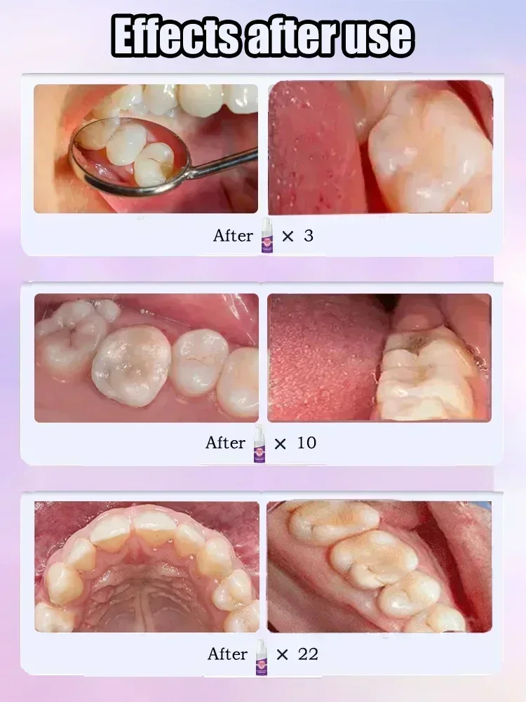 Reparación de caries, reparaci - Teeth Whitening Charcoal Powder reseña y precio