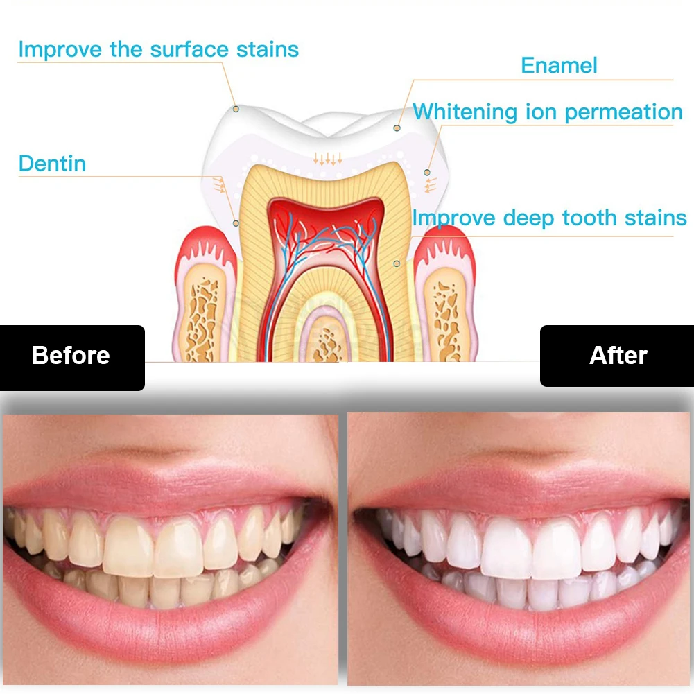 Kit de blanqueamiento Dental M - Teeth Whitening Bleaching Kit reseña y precio